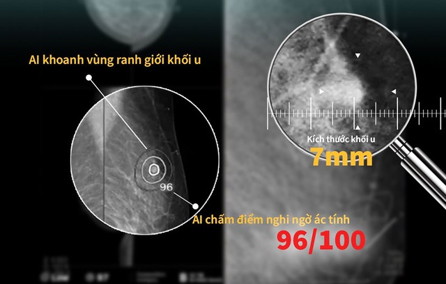 AI đánh giá u vú
