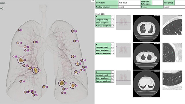 Hình ảnh chụp CT lồng ngực có kết hợp công nghệ AI